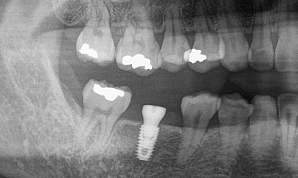Our Services - Dental Implants