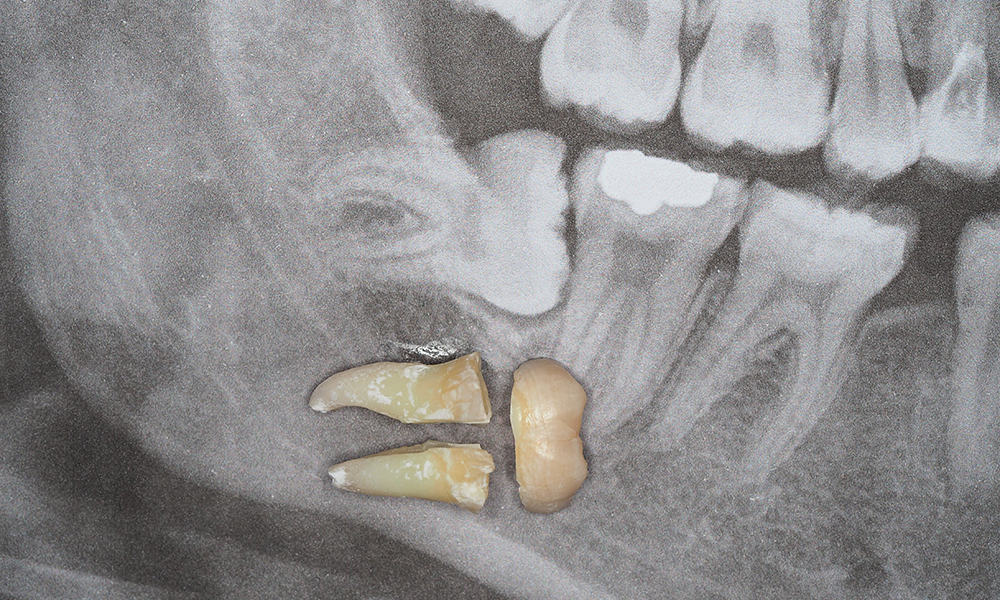 Our Services - Wisdom Tooth Surgery