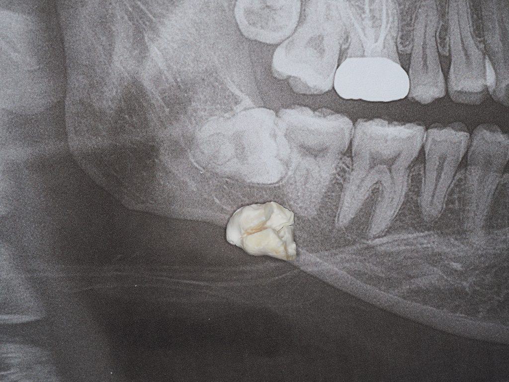 Wisdom Tooth Surgery 3